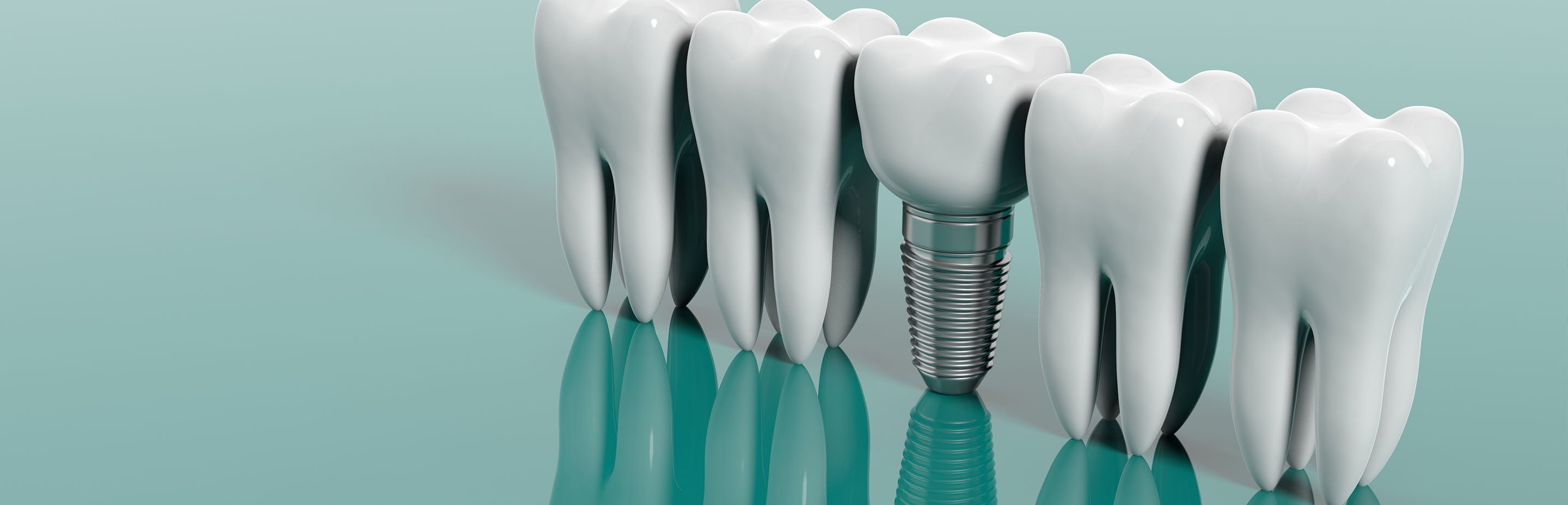Diş İmplantı Nedir ve Hangi Durumlarda Tercih Edilir?